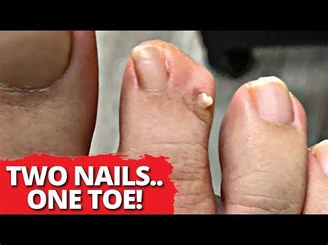 nails  toe permanent extra toenail removal toenail