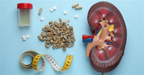 10 Ways To Prevent Kidney Stones