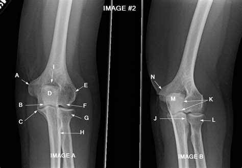 Ap and External Oblique Elbow - Image #2 Diagram | Quizlet