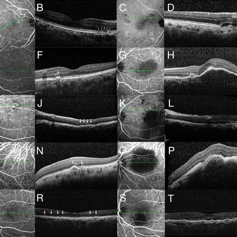 patient     year  female diagnosed  ppe   left eye