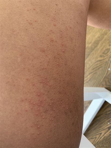 Razor Bumps On Inner Thigh R Mildlyuncomfortable