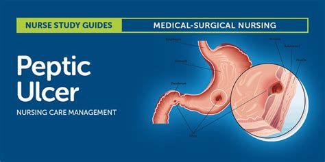 Peptic Ulcer Disease Nursing Care And Management Study Guide Peptic