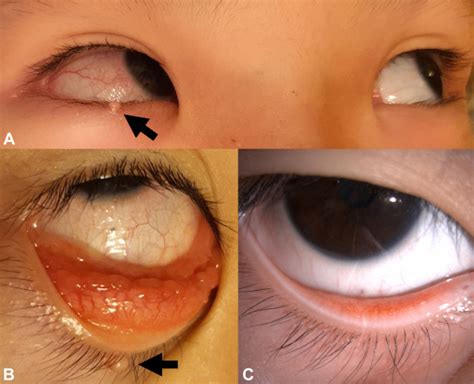 Giant Papillary Conjunctivitis Caused By A Fibroepithelial Polyp Of The