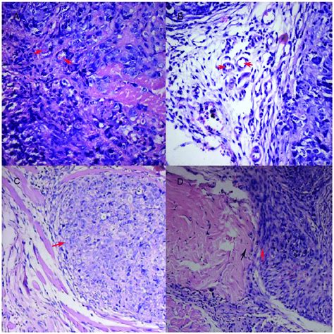 Suppression Of Tumor Invasion In Nude Mouse Xenografts By STAT ShRNA