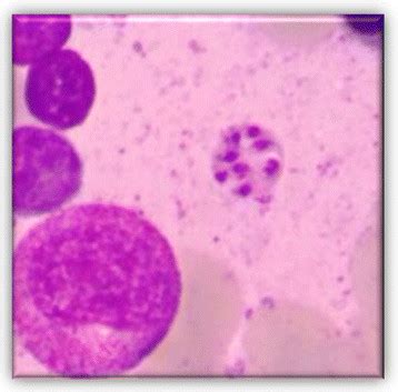 bone marrow aspirate leishman donovan bodies  macrophages