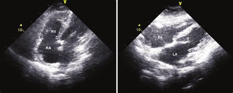 Apical four-chamber (a) and subcostal (b) view of the same patient ...