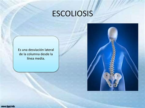 Escoliosis Generalidades Diagn Stico Y Manejo Ppt