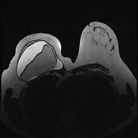 Breast Implant Associated Anaplastic Large Cell Lymphoma Radiology