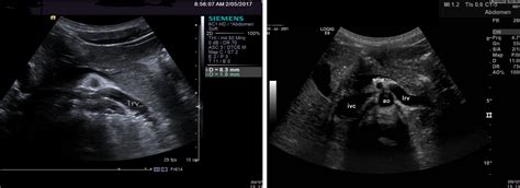 Nutcracker Syndrome A Proposed Ultrasound Protocol Englund 2018 Australasian Journal Of