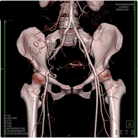 external iliac artery