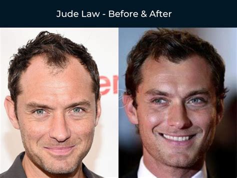 71 Celebrity Hair Transplants | Before & After Photos
