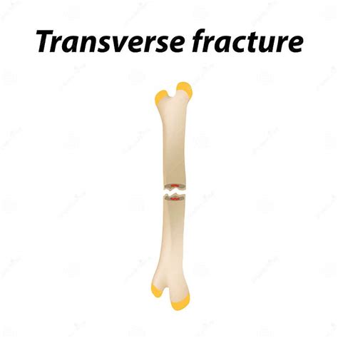 Transverse Bone Fracture Infographics Vector Illustration On A Lined