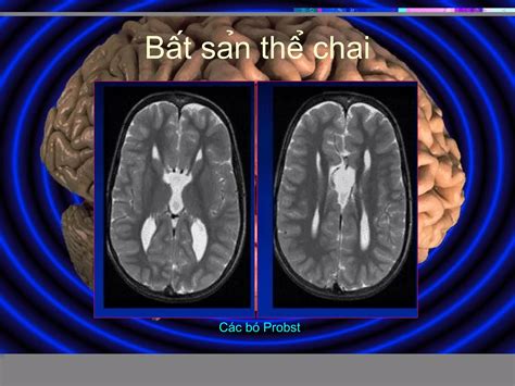 Congenital Brain Malformation Ppt