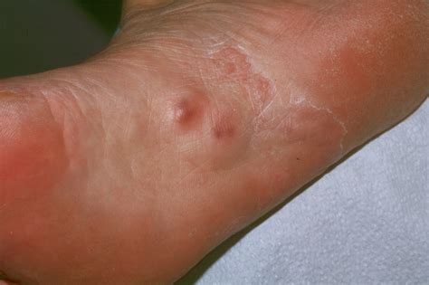 Plantar Fibroma - Symptoms, Causes, Treatment, Pictures