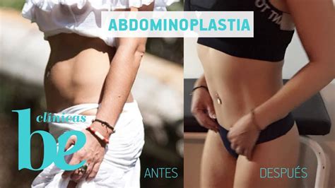 Abdominoplastia Mi Experiencia Y Resultados Cl Nicas Be Youtube