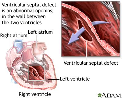 Endocardial cushion defect: MedlinePlus Medical Encyclopedia