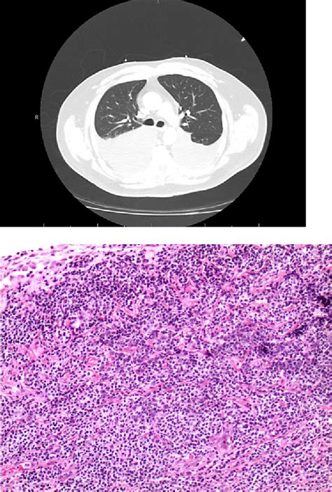 Figure 1 From Primary Pleural Extranodal Marginal Zone Lymphoma Presenting As Bilateral