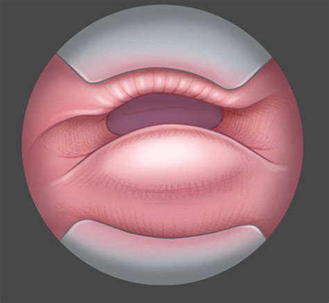 Endoscopic Cricopharyngeal Myotomy Operative Techniques In