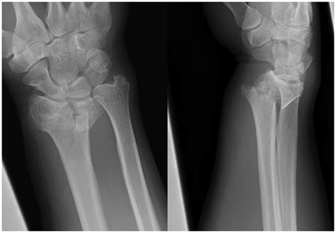 Colles Fracture Backslab