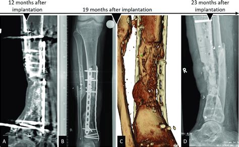 Complete Bone Regeneration Achieved In An Extra Large Tibial Segmental