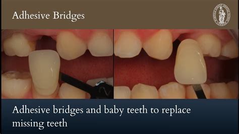 Adhesive Bridges And Baby Teeth To Replace Missing Teeth Case Of The