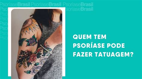 Aprender Sobre 96 Imagem Quem Tem Queloide Pode Fazer Tatuagem Br