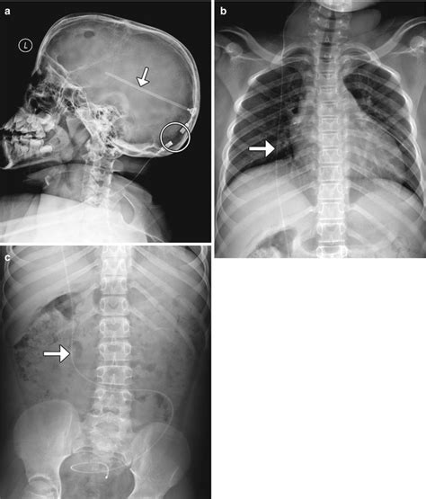 Codman Programmable Shunt Brain