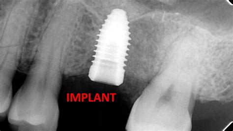 Sinus Lift With Dental Implant Surgery Youtube