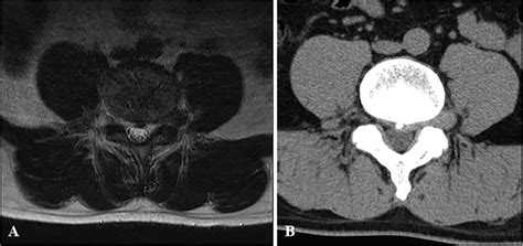 Preoperative Magnetic Resonance Imaging A And Computed Tomography