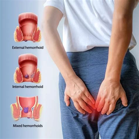 Sdottor Anal Fissure Soothing Swelling Hemorrhoid Ointment Relieve Pain Anti Itch Cream Treat