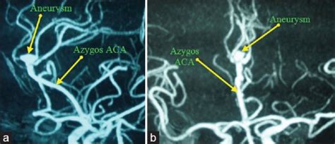 Aneurysm Of Azygos Anterior Cerebral Artery A Report Of Two Cases