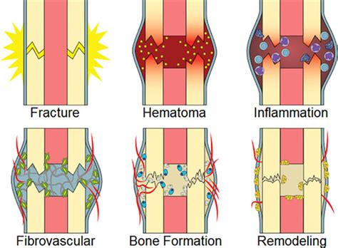 Cellular Biology Of Fracture Healing Bahney 2019 Journal Of