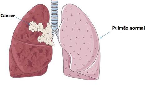 C Ncer De Pulm O Medicina Respirat Ria