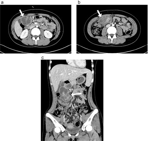 Contrast Enhanced Abdomen Pelvis Computed Tomography A B Axial