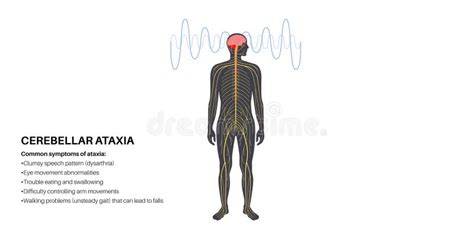 Ataxia Cerebellar Disorder Stock Vector Illustration Of Slurred