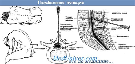 Лечение головной боли после пункции