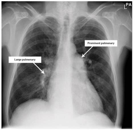 Pulmonary Hypertension Cor Pulmonale Other Rare Pulm Disorders