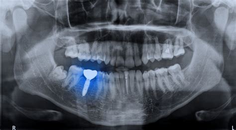 Are Dental Implants Covered By Medi Cal Dental News Network
