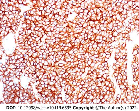 Histologic specimen (immunohistochemical stain, immunohistochemistry ...