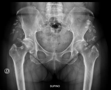 Dystrophic Calcifications Secondary To Intramuscular Injections Elaiomi Image