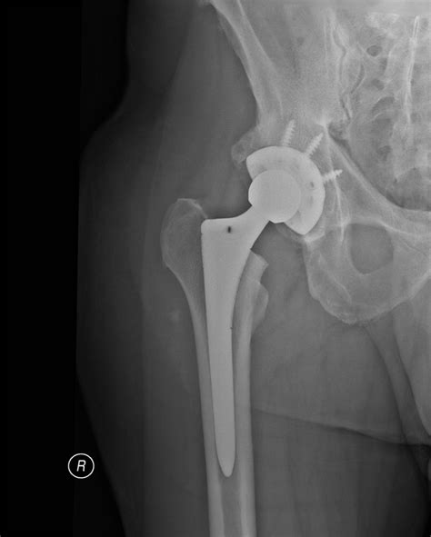 Total Hip Replacement Esskay Ortho And Eye Care