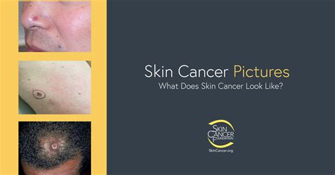 Skin Cancer Pictures