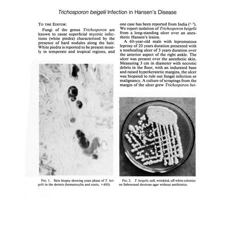 (PDF) Trichosporon beigelii infection in Hansen's disease