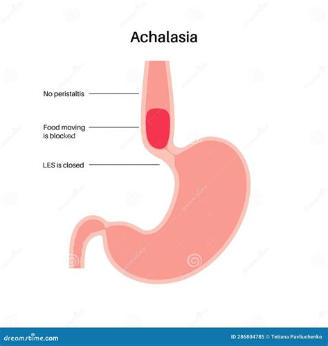 Esophageal Achalasia Disease Stock Illustration Illustration Of