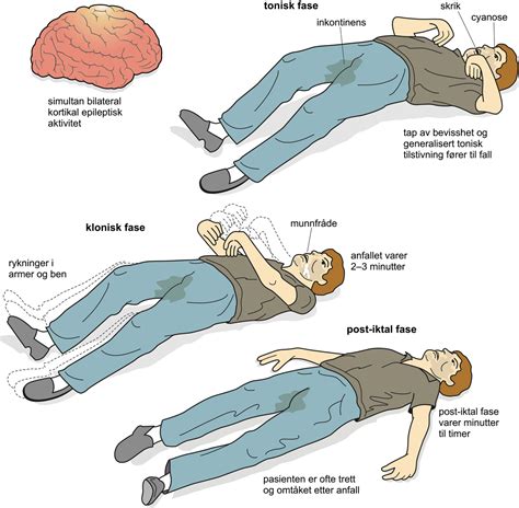 Epilepsi Store Medisinske Leksikon
