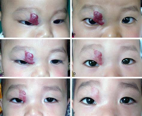 Figure 2 From Management Of Periorbital Hemangioma By Intralesional