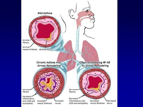 Asthma Definition Pathophysiology Pathogenesis 1 Asthma Is A