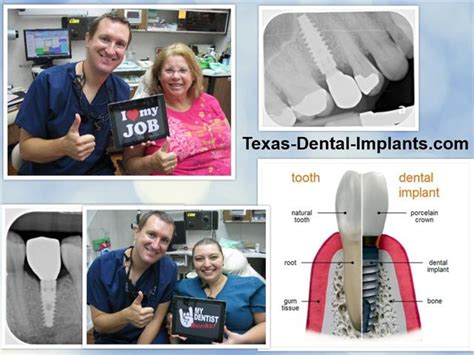 Replace Missing Teeth With A Dental Implant Pasadena Tx