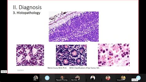 Jcs 13 Genetics And Molecular Pathology Of Retinoblastoma Youtube