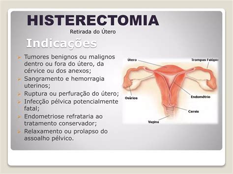 Histerectomia Cuidados De Enfermagem Ppt